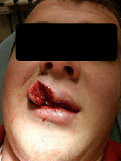 rotura de labio abierto