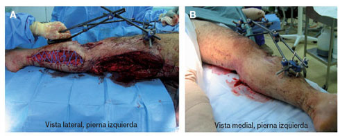 operacion pierna